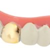 Dentier rigide avec p‚te - dent or