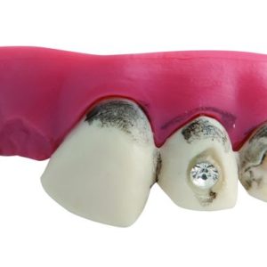 Dentier rigide avec p‚te - dents sales avec faux diamant
