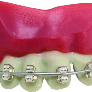 Dentier rigide avec p‚te - appareil dentaire