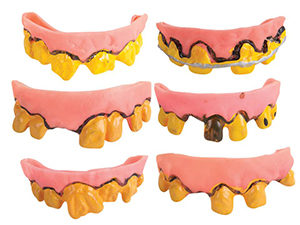 Dentier souple - modËles assortis