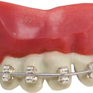 Dentier rigide avec p‚te - appareil dentaire